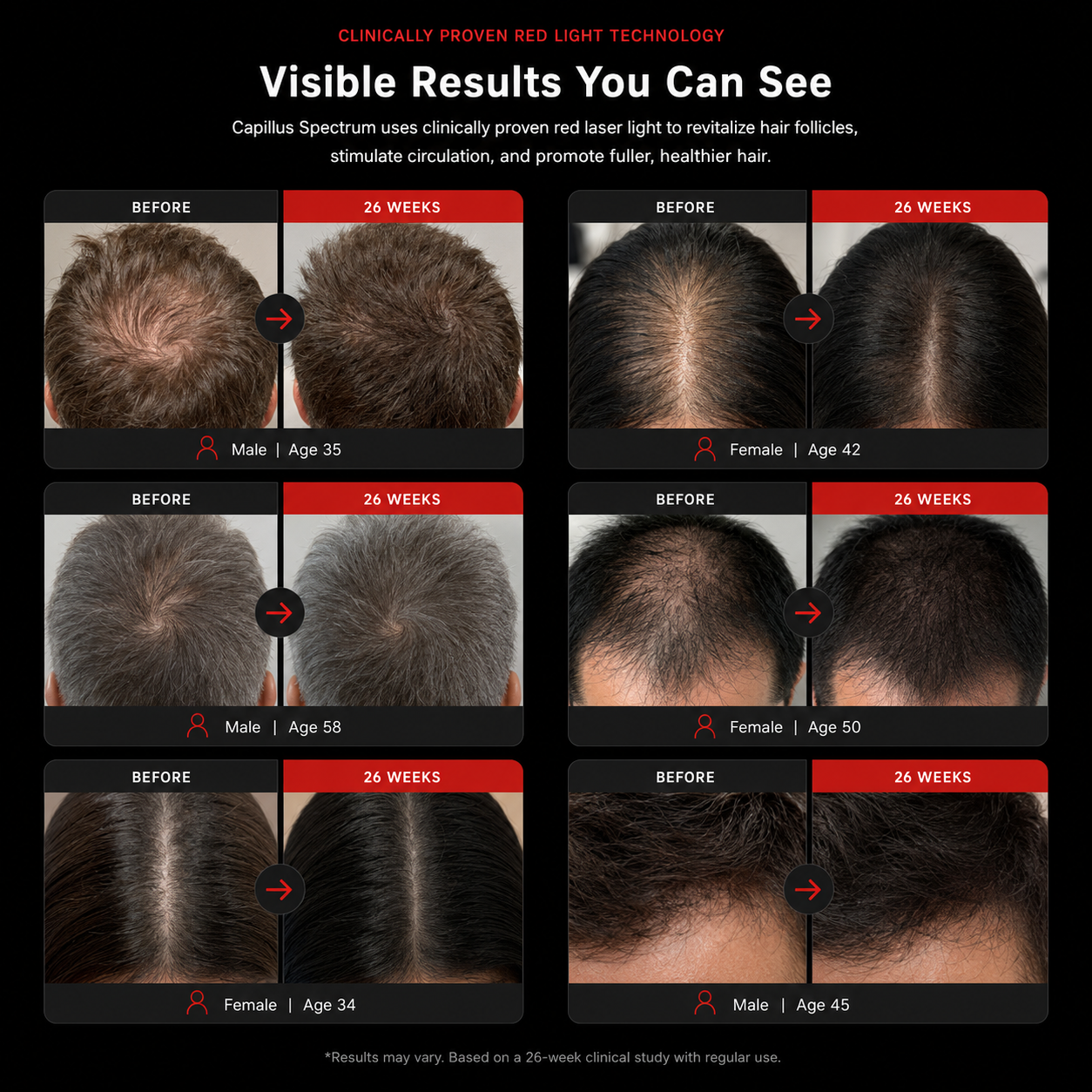 NeoStrand™ Elite | Advanced Full Laser Hair Recovery System