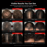 NeoStrand™ Elite | Advanced Full Laser Hair Recovery System