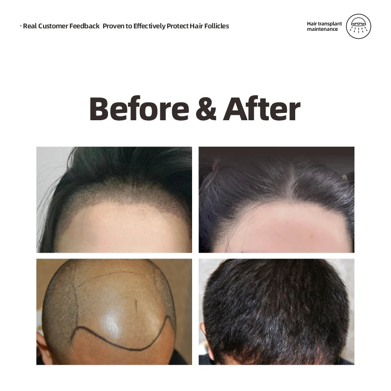 212 LLLT Red Light Laser Cap for Hair Regrowth – Stop Hair Loss, Strengthen Roots, Promote Thicker Hair