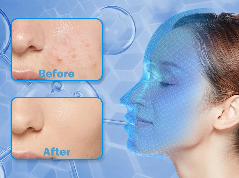 Wireless Red & Near Infrared LED Light Therapy Face Mask - 4-Color, 240 LEDs - Anti-Aging & Acne Treatment for Home Use