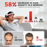 Hybrid Laser & LED Hair Wellness Cap | Professional 58-Light Scalp Recovery System | 28 Laser Diodes & 30 High-Intensity LEDs
