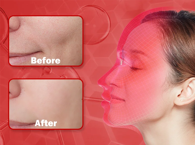 Wireless Red & Near Infrared LED Light Therapy Face Mask - 4-Color, 240 LEDs - Anti-Aging & Acne Treatment for Home Use