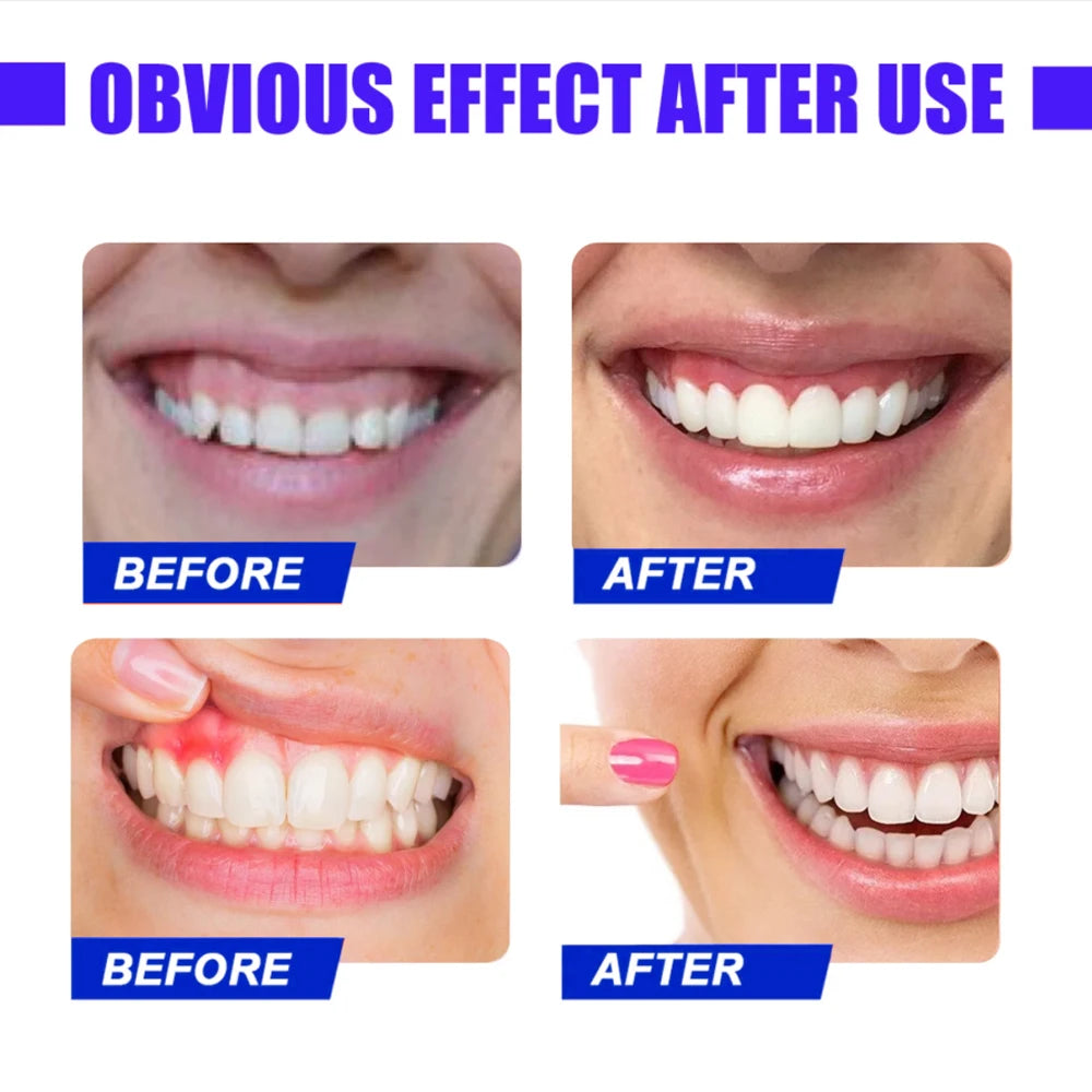 Red Light Therapy for Gums & Teeth, 625nm LED Oral Care Device for Periodontal Treatment, Toothache & Sensitivity Relief