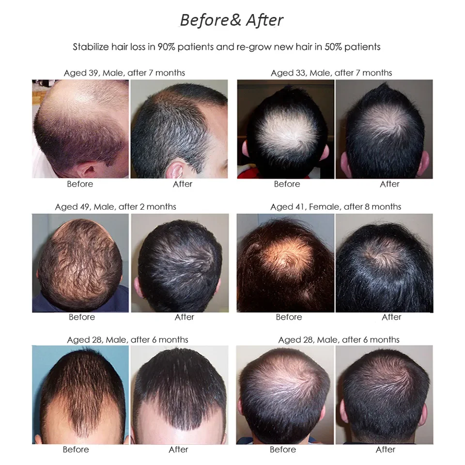 Hybrid Laser & LED Hair Growth Cap for Men & Women, 650nm Red Light Therapy Scalp Device for Thinning Hair & Hair Regrowth