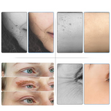 Plasma Pen Eyelid Lifting, Laser Tattoo & Dark Spot Remover with 3 Needles